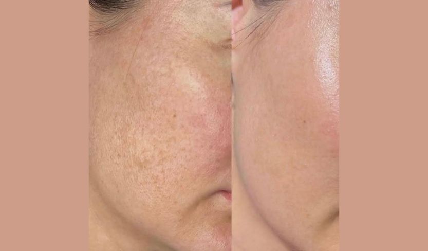 peeling schiarente jesolo