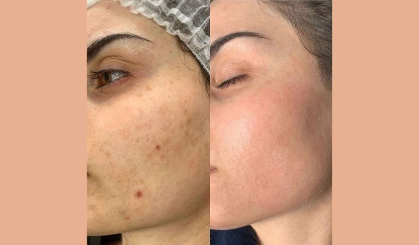 trattamento peeling schiarente