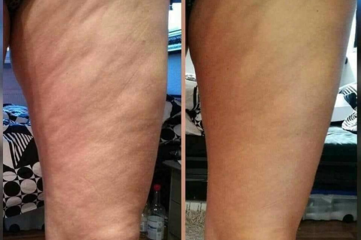 radiofrequenza estetica gambe