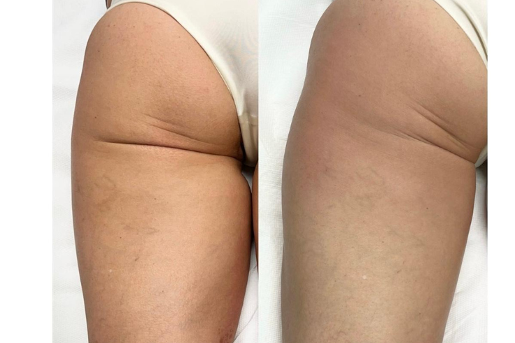 Radiofrequenza estetica glutei