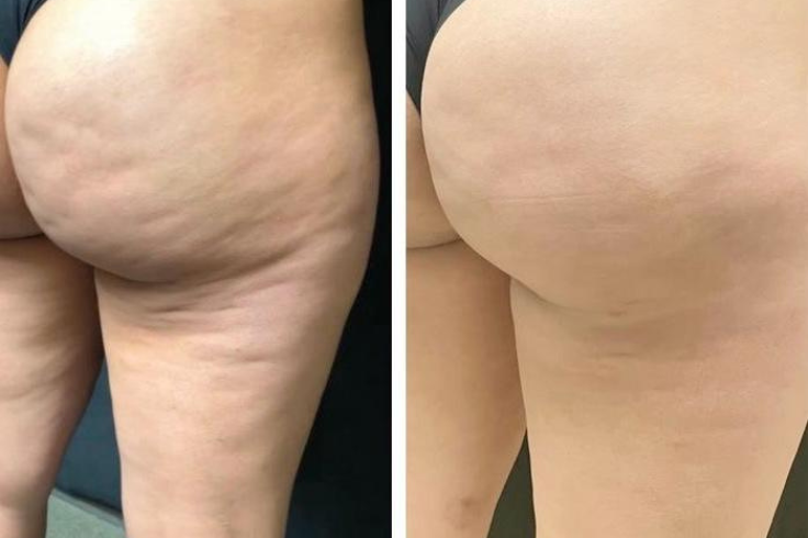 radiofrequenza estetica glutei