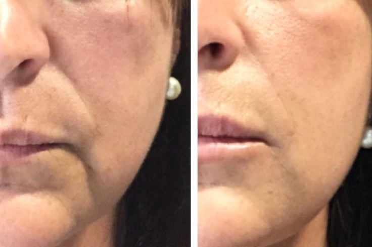 radiofrequenza estetica viso