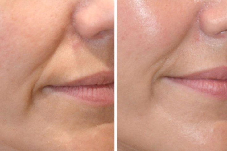 radiofrequenza estetica viso